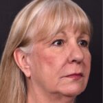 Before and after rhinoplasty results showing improved nasal shape and facial balance by Dr. Inessa Fishman at Aviva Plastic Surgery in Atlanta. Rhinoplasty nose job before and afer best expert near me collagen surgery plastic surgeon expert