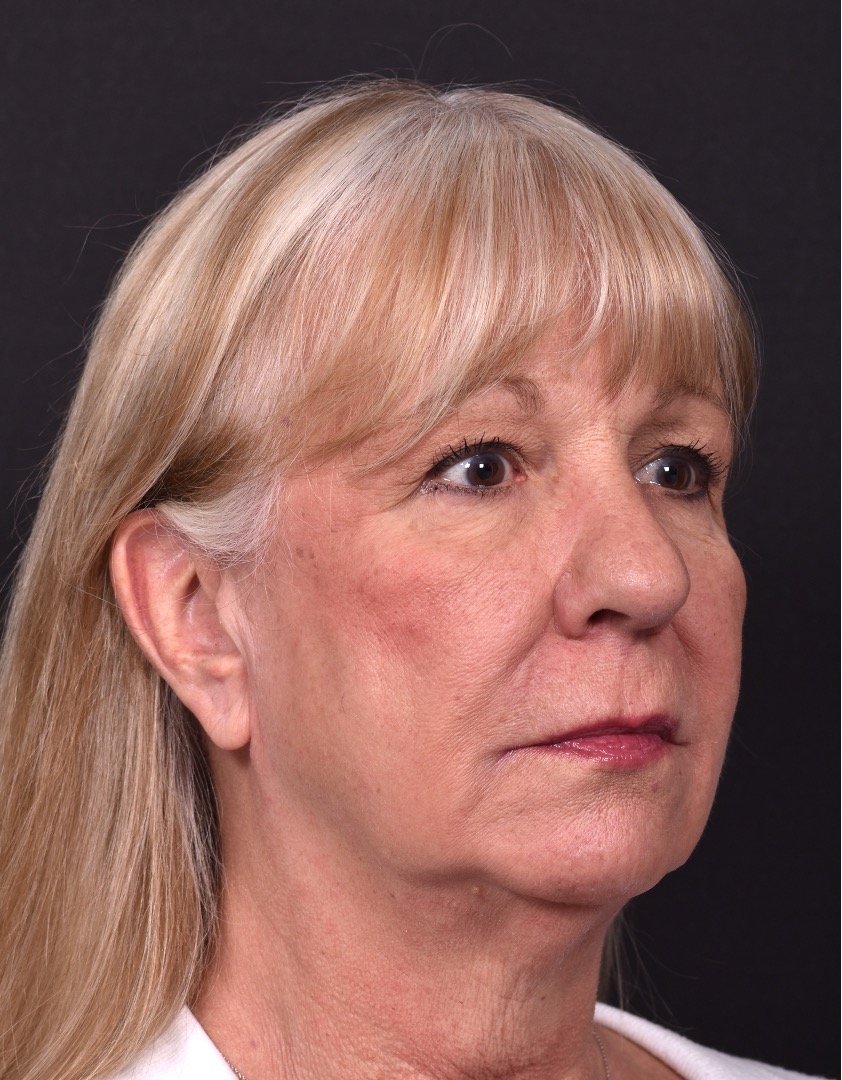 Before and after rhinoplasty results showing improved nasal shape and facial balance by Dr. Inessa Fishman at Aviva Plastic Surgery in Atlanta. Rhinoplasty nose job before and afer best expert near me collagen surgery plastic surgeon expert