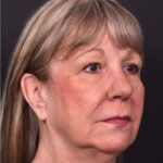 Before and after rhinoplasty results showing improved nasal shape and facial balance by Dr. Inessa Fishman at Aviva Plastic Surgery in Atlanta. Rhinoplasty nose job before and afer best expert near me collagen surgery plastic surgeon expert