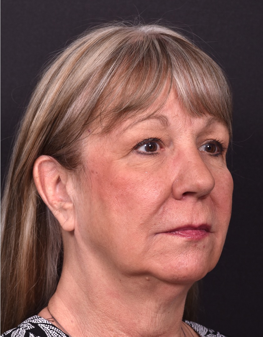 Before and after rhinoplasty results showing improved nasal shape and facial balance by Dr. Inessa Fishman at Aviva Plastic Surgery in Atlanta. Rhinoplasty nose job before and afer best expert near me collagen surgery plastic surgeon expert