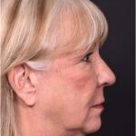 Before and after rhinoplasty results showing improved nasal shape and facial balance by Dr. Inessa Fishman at Aviva Plastic Surgery in Atlanta. Rhinoplasty nose job before and afer best expert near me collagen surgery plastic surgeon expert