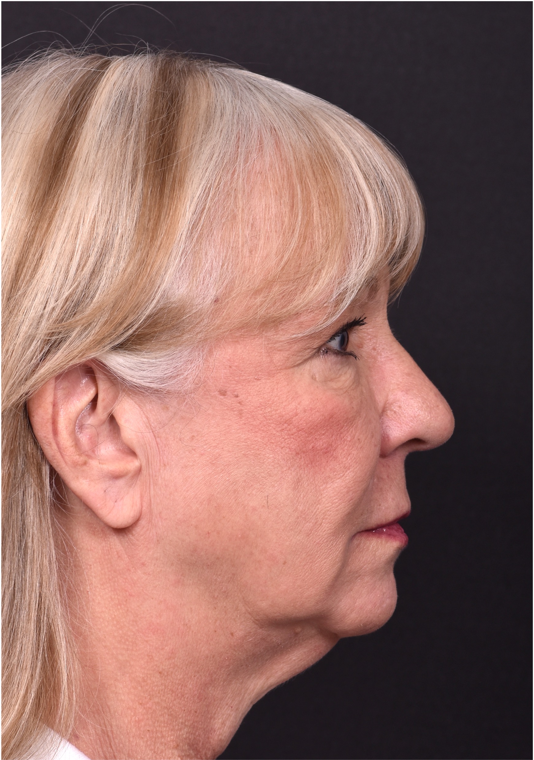 Before and after rhinoplasty results showing improved nasal shape and facial balance by Dr. Inessa Fishman at Aviva Plastic Surgery in Atlanta. Rhinoplasty nose job before and afer best expert near me collagen surgery plastic surgeon expert