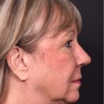 Before and after rhinoplasty results showing improved nasal shape and facial balance by Dr. Inessa Fishman at Aviva Plastic Surgery in Atlanta. Rhinoplasty nose job before and afer best expert near me collagen surgery plastic surgeon expert