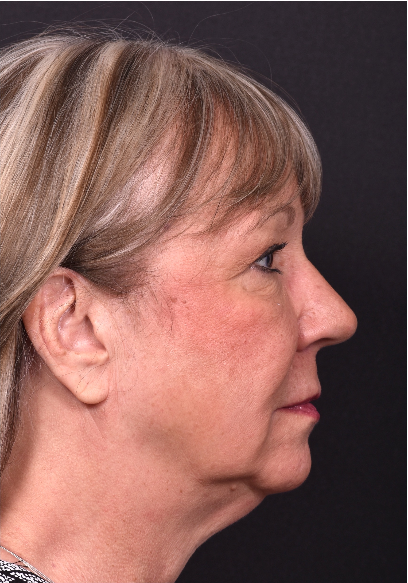 Before and after rhinoplasty results showing improved nasal shape and facial balance by Dr. Inessa Fishman at Aviva Plastic Surgery in Atlanta. Rhinoplasty nose job before and afer best expert near me collagen surgery plastic surgeon expert