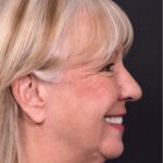 Before and after rhinoplasty results showing improved nasal shape and facial balance by Dr. Inessa Fishman at Aviva Plastic Surgery in Atlanta. Rhinoplasty nose job before and afer best expert near me collagen surgery plastic surgeon expert