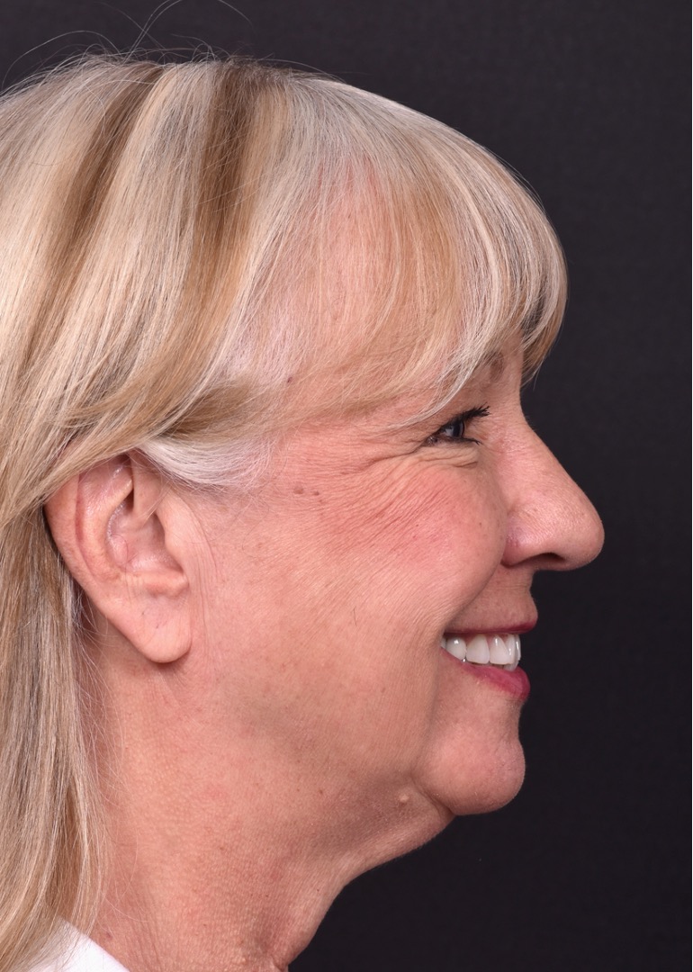 Before and after rhinoplasty results showing improved nasal shape and facial balance by Dr. Inessa Fishman at Aviva Plastic Surgery in Atlanta. Rhinoplasty nose job before and afer best expert near me collagen surgery plastic surgeon expert