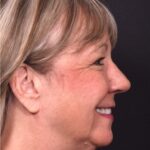 Before and after rhinoplasty results showing improved nasal shape and facial balance by Dr. Inessa Fishman at Aviva Plastic Surgery in Atlanta. Rhinoplasty nose job before and afer best expert near me collagen surgery plastic surgeon expert