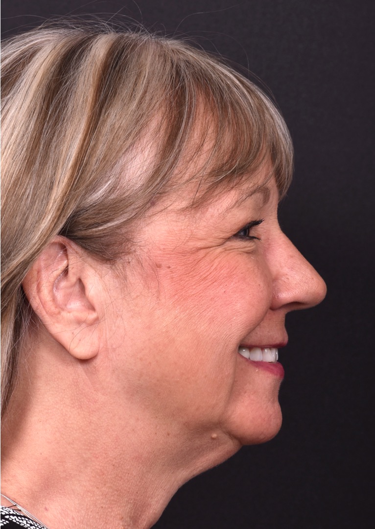 Before and after rhinoplasty results showing improved nasal shape and facial balance by Dr. Inessa Fishman at Aviva Plastic Surgery in Atlanta. Rhinoplasty nose job before and afer best expert near me collagen surgery plastic surgeon expert