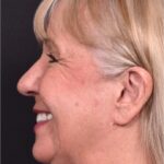 Before and after rhinoplasty results showing improved nasal shape and facial balance by Dr. Inessa Fishman at Aviva Plastic Surgery in Atlanta. Rhinoplasty nose job before and afer best expert near me collagen surgery plastic surgeon expert