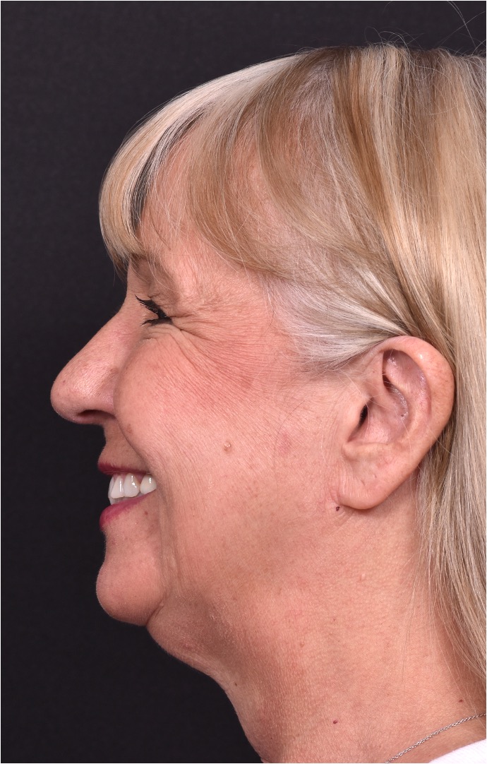 Before and after rhinoplasty results showing improved nasal shape and facial balance by Dr. Inessa Fishman at Aviva Plastic Surgery in Atlanta. Rhinoplasty nose job before and afer best expert near me collagen surgery plastic surgeon expert