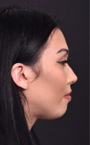 Facial balancing near me best expert before after results female plastic surgeon collagen skin