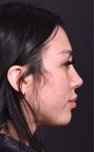 Facial balancing near me best expert before after results female plastic surgeon collagen skin