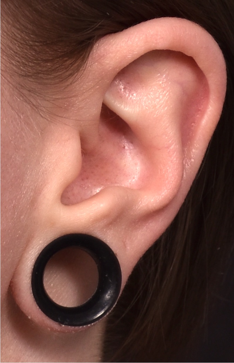 Gauged gauges earlobe ear repair near me best scarless collagen Atlanta plastic surgeon