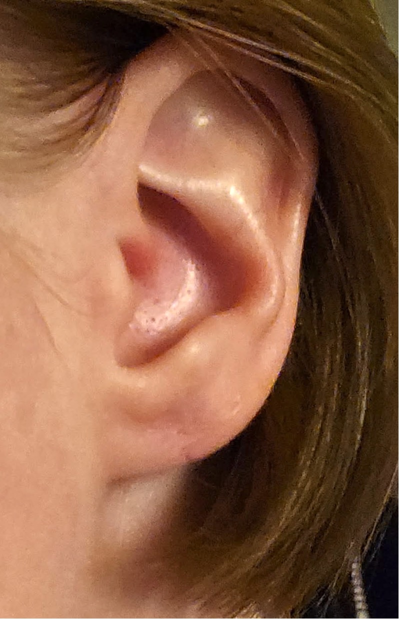 Gauged gauges earlobe ear repair near me best scarless collagen Atlanta plastic surgeon