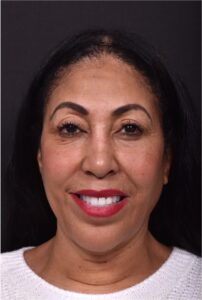 Atlanta lip lift near me facial balancing collagen art results before after