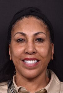 Atlanta lip lift near me facial balancing collagen art results before after