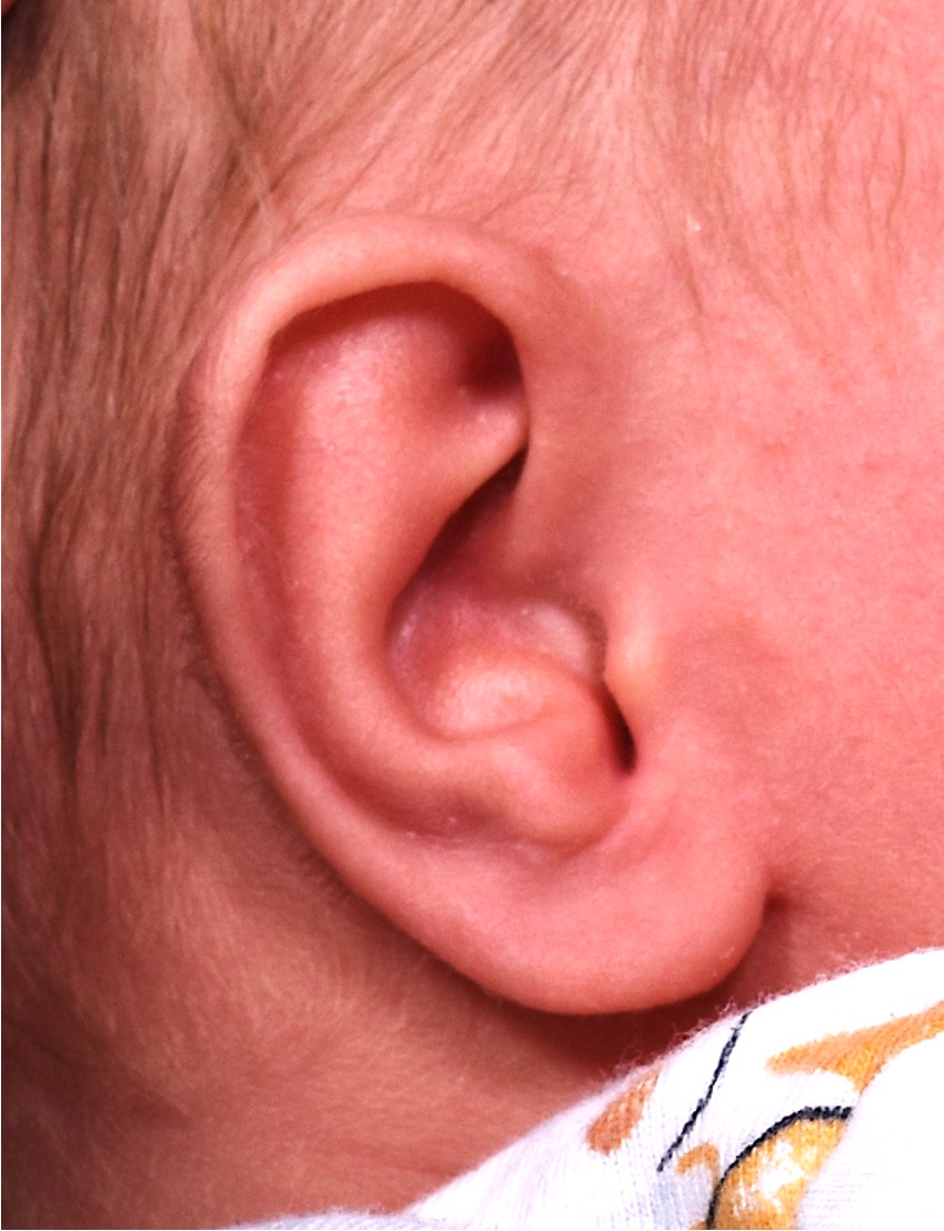 Earwell best near me Atlanta ear baby congenital otoplasty collagen results before and after