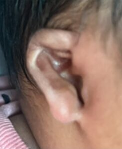 Earwell Atlanta microtia baby ear deformity treatment nonsurgical best near me before after otoplasty collagen