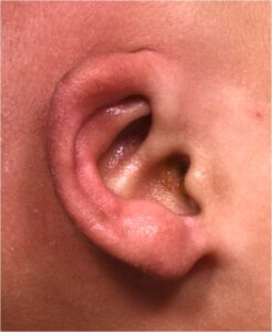 Earwell Atlanta microtia baby ear deformity treatment nonsurgical best near me before after otoplasty collagen