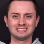 Male rhinoplasty expert near me best expert before and after results septoplasty crooked nose Atlanta collagen