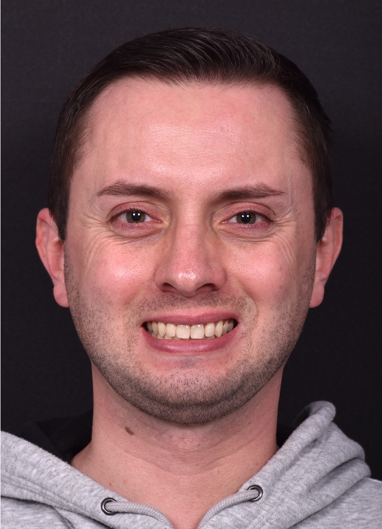 Male rhinoplasty expert near me best expert before and after results septoplasty crooked nose Atlanta collagen