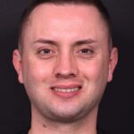 Male rhinoplasty expert near me best expert before and after results septoplasty crooked nose Atlanta collagen