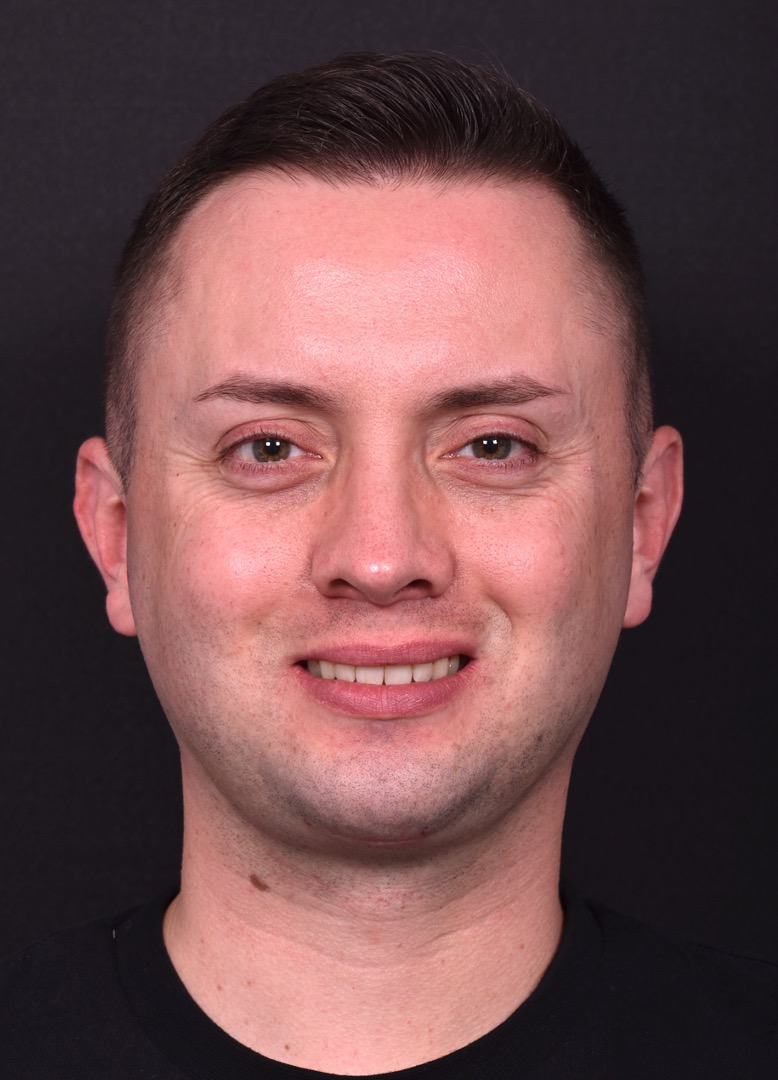 Male rhinoplasty expert near me best expert before and after results septoplasty crooked nose Atlanta collagen