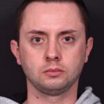 Male rhinoplasty expert near me best expert before and after results septoplasty crooked nose Atlanta collagen