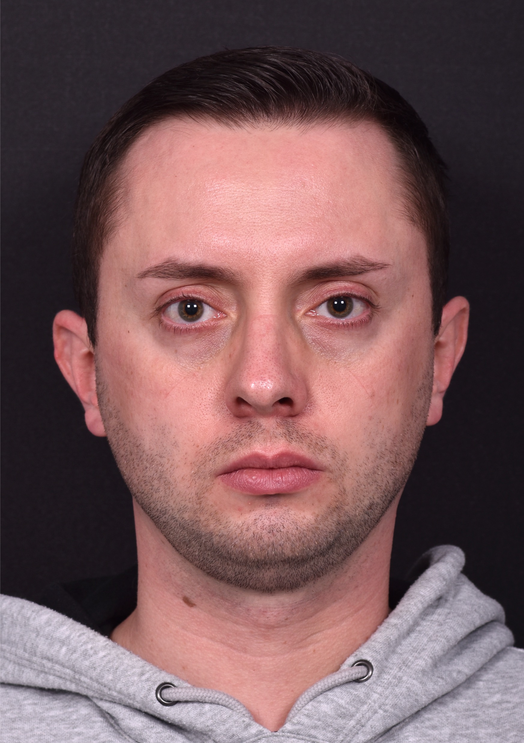 Male rhinoplasty expert near me best expert before and after results septoplasty crooked nose Atlanta collagen