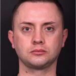 Male rhinoplasty expert near me best expert before and after results septoplasty crooked nose Atlanta collagen