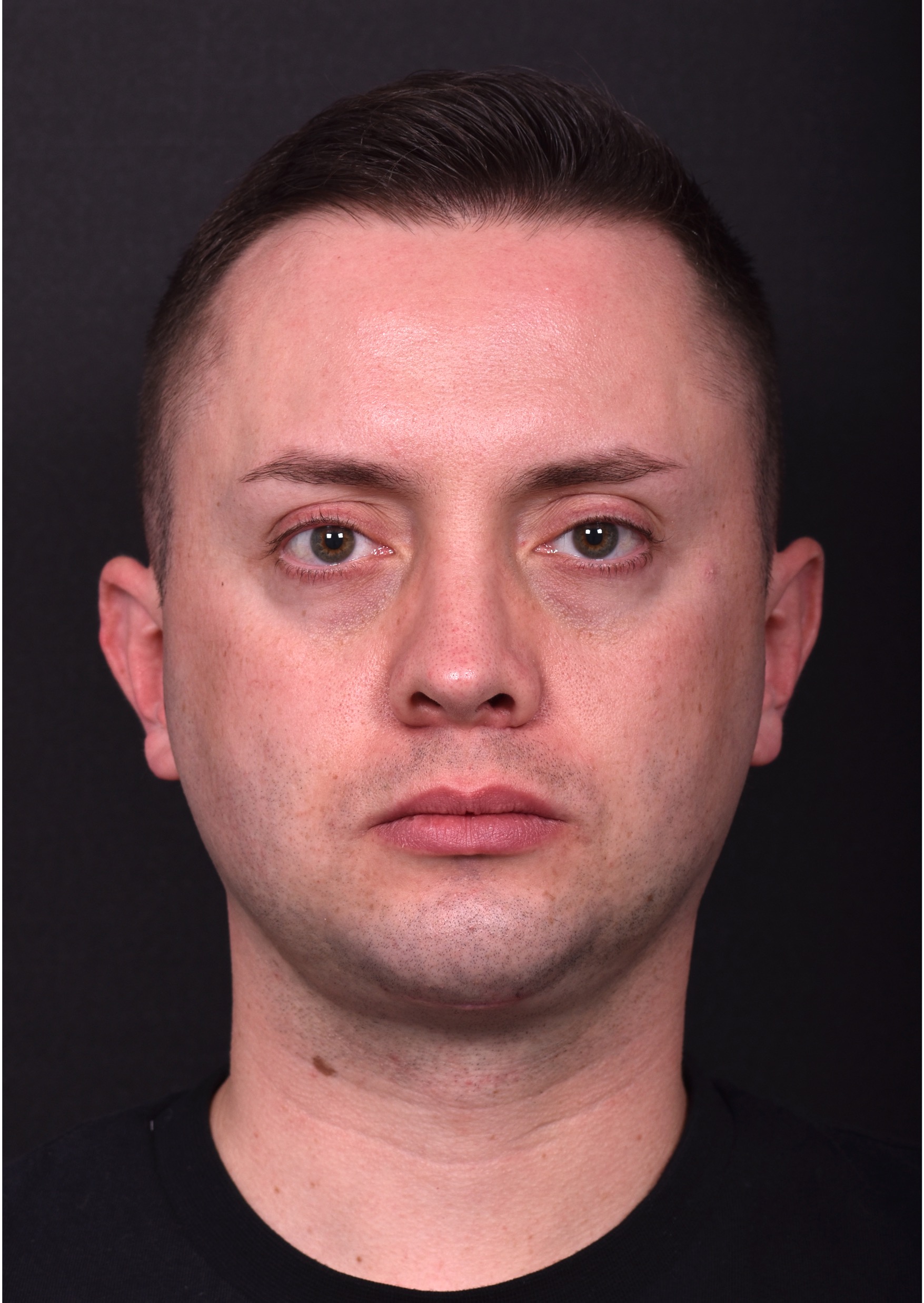 Male rhinoplasty expert near me best expert before and after results septoplasty crooked nose Atlanta collagen