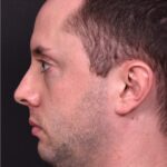 Male rhinoplasty expert near me best expert before and after results septoplasty crooked nose Atlanta collagen