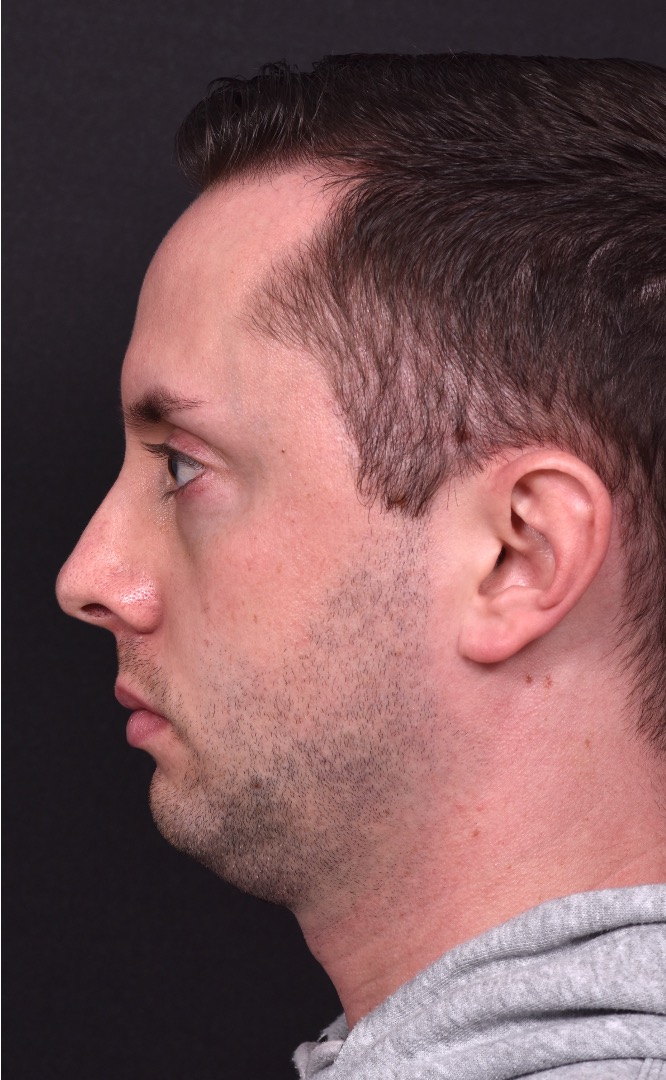 Male rhinoplasty expert near me best expert before and after results septoplasty crooked nose Atlanta collagen