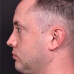 Male rhinoplasty expert near me best expert before and after results septoplasty crooked nose Atlanta collagen
