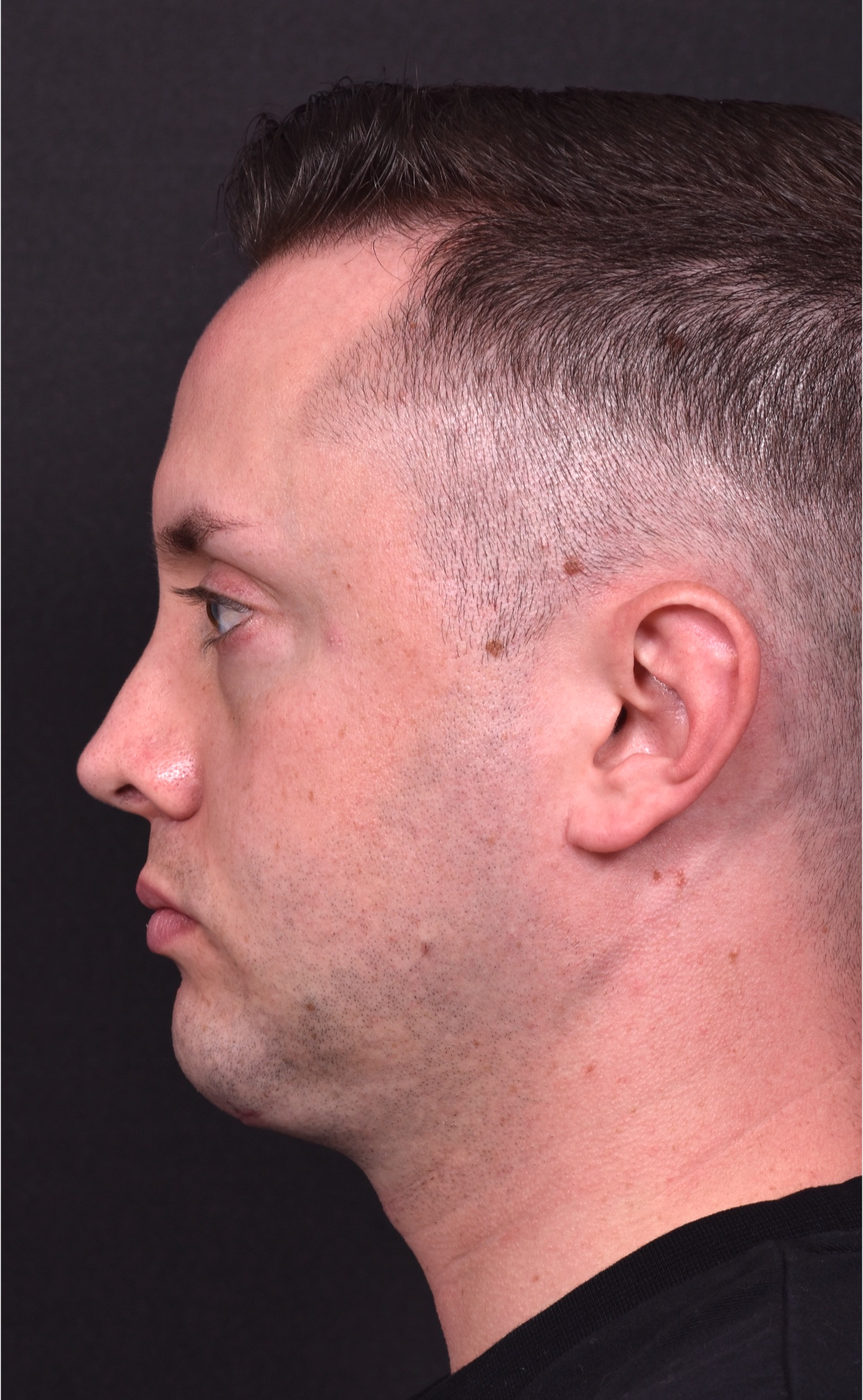 Male rhinoplasty expert near me best expert before and after results septoplasty crooked nose Atlanta collagen