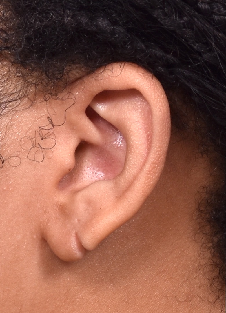 Atlanta earlobe repair torn stretched piercing gauge results before and after best near me collagen