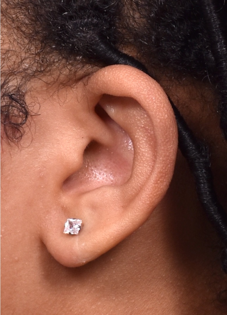 Atlanta earlobe repair torn stretched piercing gauge results before and after best near me collagen