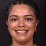 Atlanta lipoma osteoma bump forehead scarless collagen surgery results best plastic surgeon near me endoscopic laparoscopic