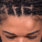 Atlanta lipoma osteoma bump forehead scarless collagen surgery results best plastic surgeon near me endoscopic laparoscopic