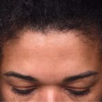 Atlanta lipoma osteoma bump forehead scarless collagen surgery results best plastic surgeon near me endoscopic laparoscopic