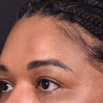 Atlanta lipoma osteoma bump forehead scarless collagen surgery results best plastic surgeon near me endoscopic laparoscopic