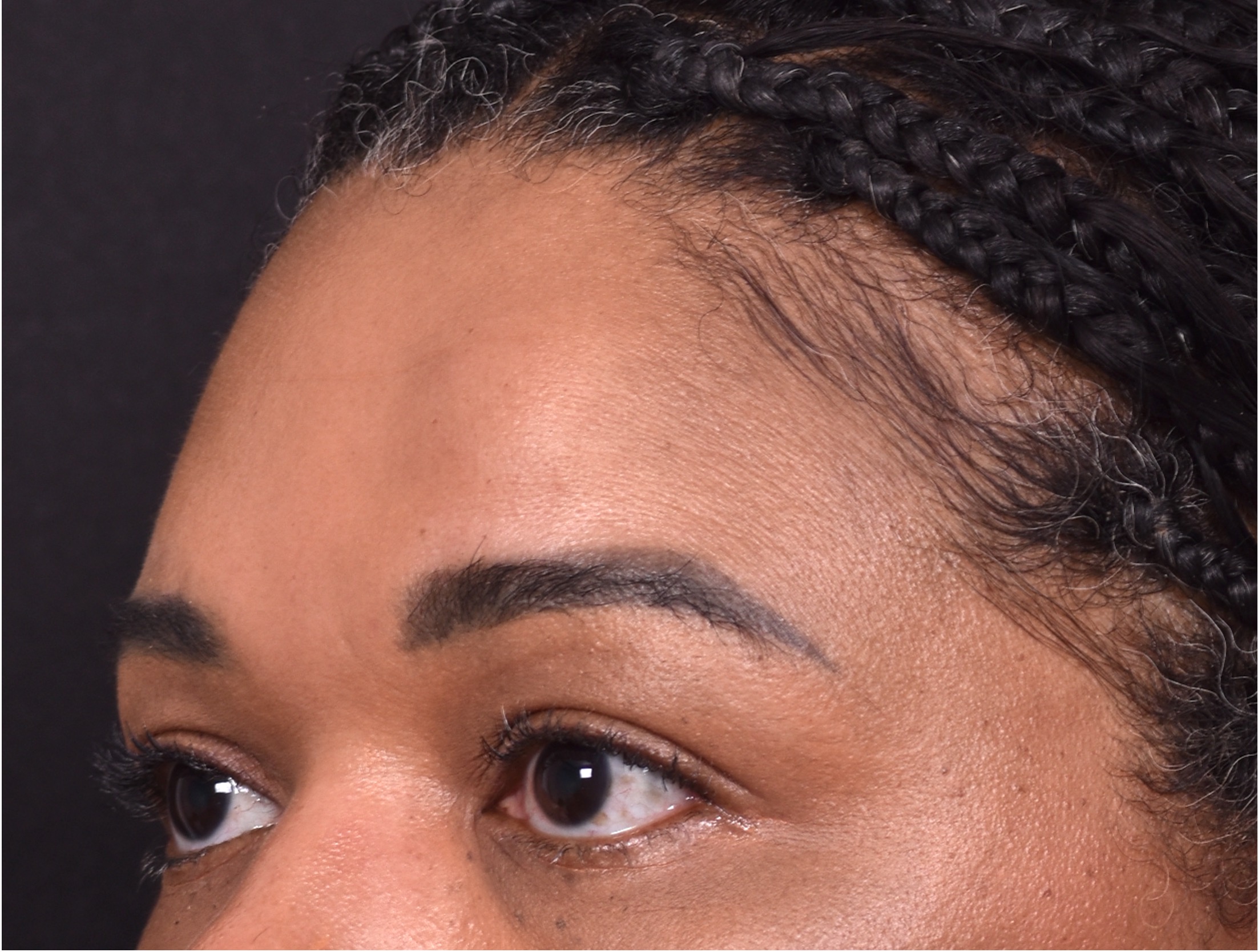 Atlanta lipoma osteoma bump forehead scarless collagen surgery results best plastic surgeon near me endoscopic laparoscopic