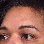 Atlanta lipoma osteoma bump forehead scarless collagen surgery results best plastic surgeon near me endoscopic laparoscopic