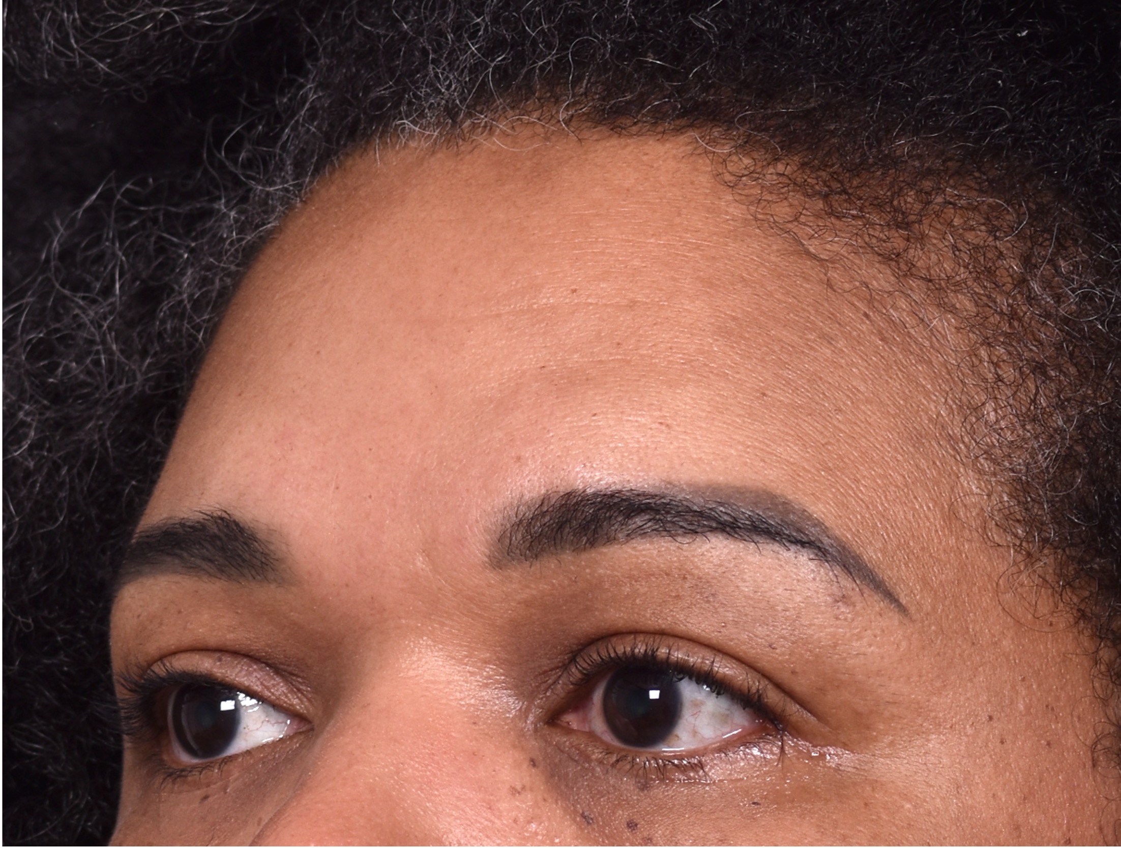 Atlanta lipoma osteoma bump forehead scarless collagen surgery results best plastic surgeon near me endoscopic laparoscopic