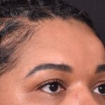 Atlanta lipoma osteoma bump forehead scarless collagen surgery results best plastic surgeon near me endoscopic laparoscopic