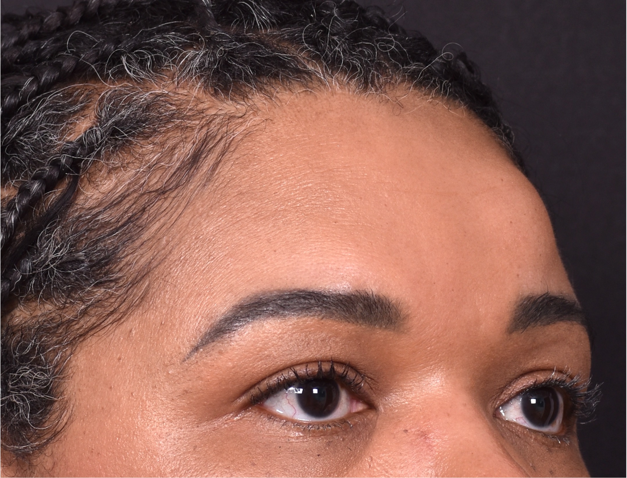 Atlanta lipoma osteoma bump forehead scarless collagen surgery results best plastic surgeon near me endoscopic laparoscopic