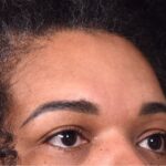 Atlanta lipoma osteoma bump forehead scarless collagen surgery results best plastic surgeon near me endoscopic laparoscopic