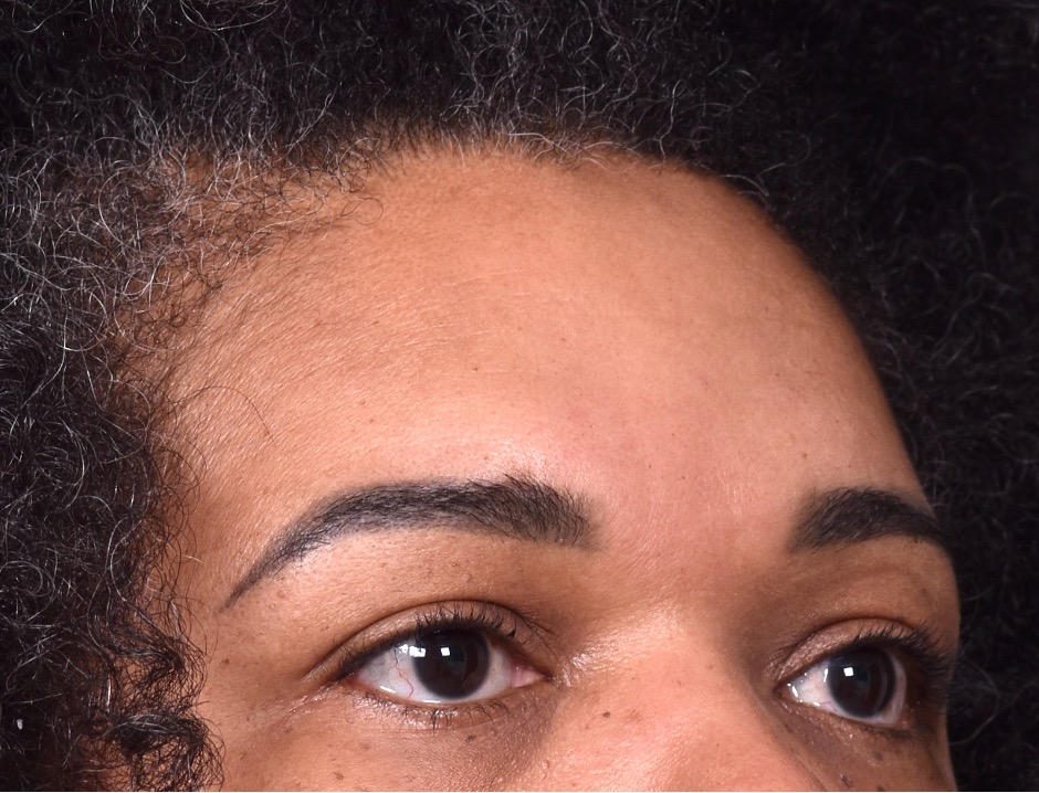 Atlanta lipoma osteoma bump forehead scarless collagen surgery results best plastic surgeon near me endoscopic laparoscopic