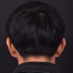 Otoplasty Atlanta ear pinning surgery before after results best near me plastic surgeon collagen earlobe