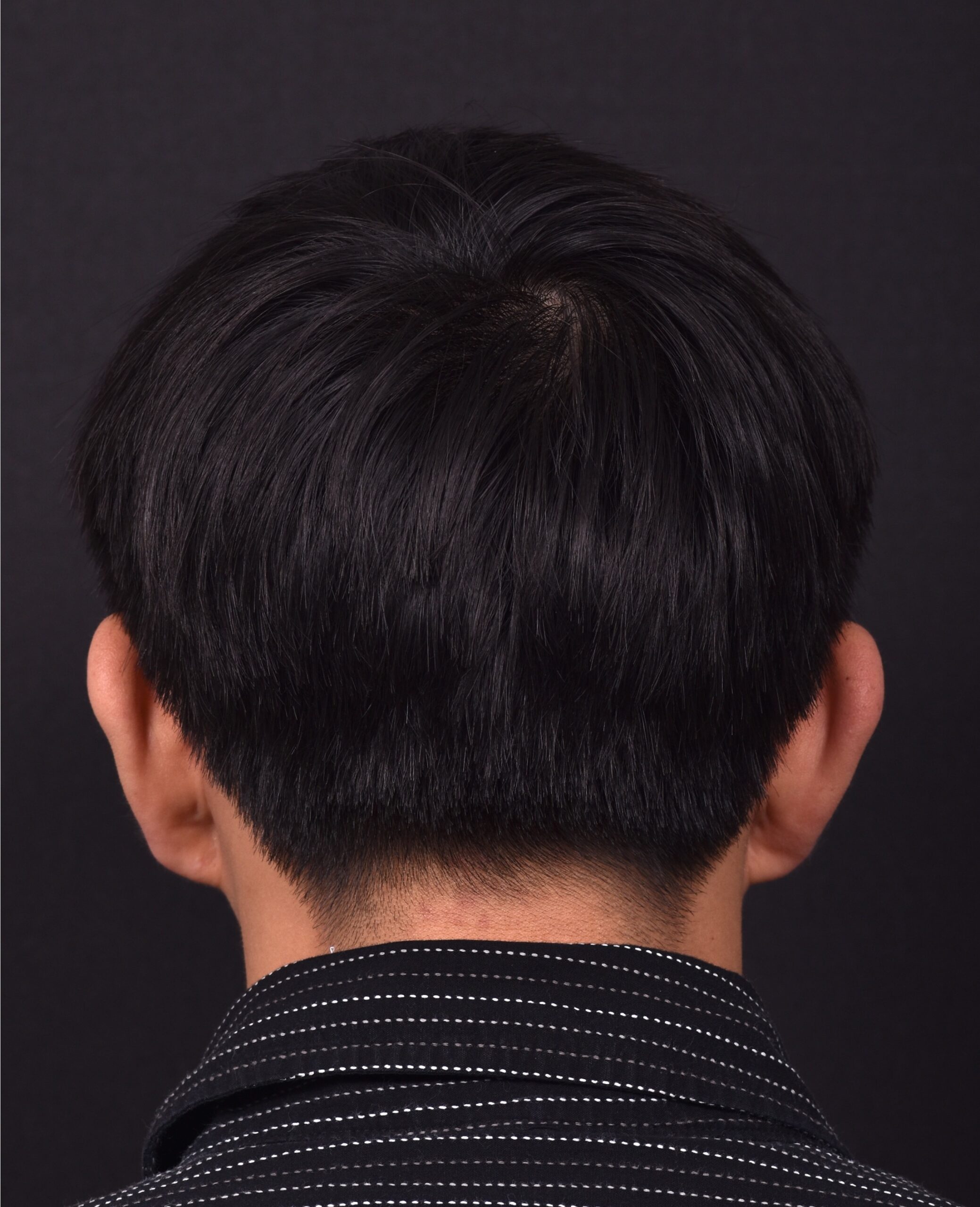 Otoplasty Atlanta ear pinning surgery before after results best near me plastic surgeon collagen earlobe
